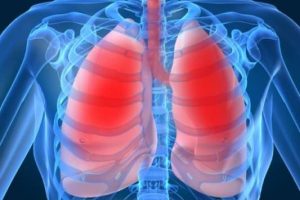 Remedios naturales para la bronquitis