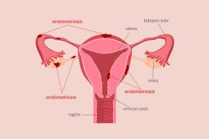 Remedios Naturales para la Endometriosis