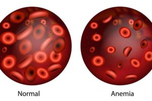 Medicina Natural para la Anemia